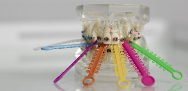 Best Braces Colors